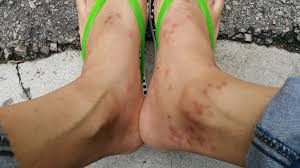 Mosquito bites on feet and legs